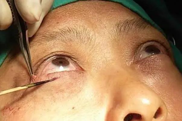 去眼袋手術費用大概多少錢 去眼袋手術有危害嗎 去眼袋手術費用大概多少錢 去眼袋手術有危害嗎