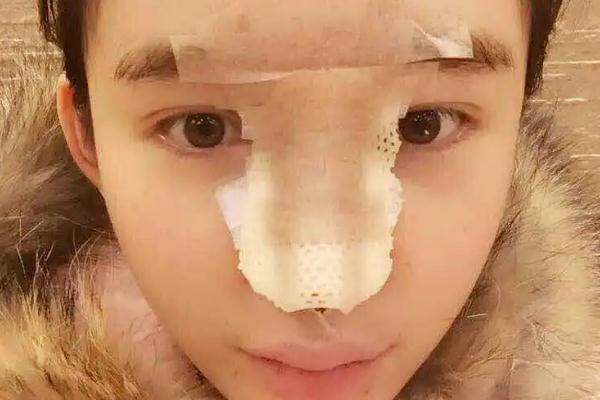 耳軟骨隆鼻有什么后遺癥 耳軟骨隆鼻有點歪可以調(diào)整嗎 耳軟骨隆鼻有什么后遺癥 耳軟骨隆鼻有點歪可以調(diào)整嗎
