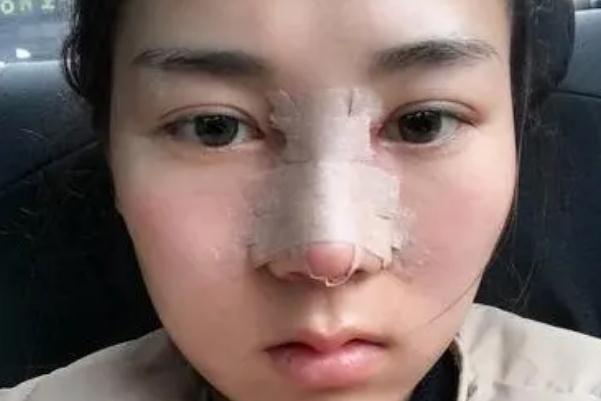耳軟骨隆鼻會(huì)攣縮嗎 耳軟骨隆鼻會(huì)變形嗎