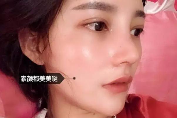 耳軟骨隆鼻有什么后遺癥 耳軟骨隆鼻有點歪可以調(diào)整嗎 耳軟骨隆鼻有什么后遺癥 耳軟骨隆鼻有點歪可以調(diào)整嗎