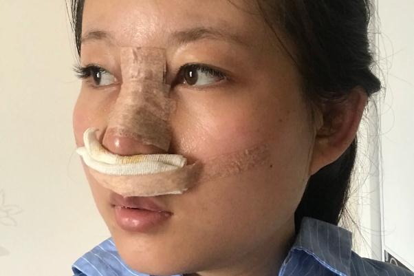 耳軟骨隆鼻會增生嗎 耳軟骨隆鼻會變低嗎 耳軟骨隆鼻會增生嗎 耳軟骨隆鼻會變低嗎