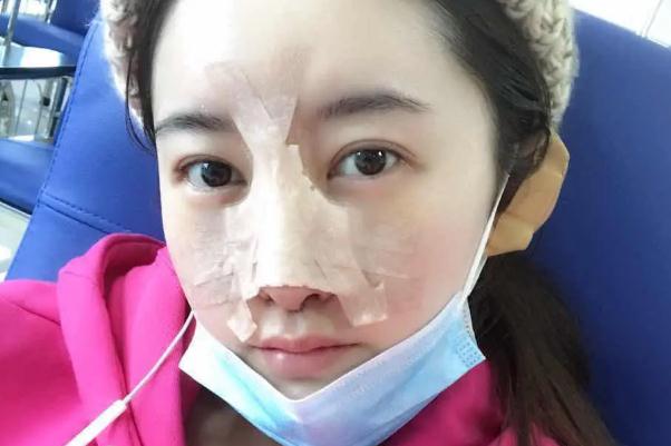 耳軟骨隆鼻是取一側還是兩側 耳軟骨隆鼻是用自己的耳軟骨嗎 耳軟骨隆鼻是取一側還是兩側 耳軟骨隆鼻是用自己的耳軟骨嗎