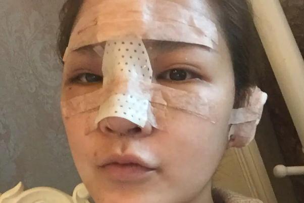 耳軟骨隆鼻有什么后遺癥 耳軟骨隆鼻有點歪可以調(diào)整嗎 耳軟骨隆鼻有什么后遺癥 耳軟骨隆鼻有點歪可以調(diào)整嗎