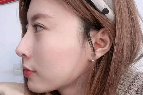 耳軟骨隆鼻耳軟骨還會長起來嗎 耳軟骨隆鼻會頂破鼻尖嗎 耳軟骨隆鼻耳軟骨還會長起來嗎 耳軟骨隆鼻會頂破鼻尖嗎