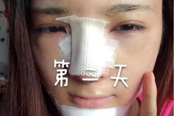 耳軟骨隆鼻是取一側還是兩側 耳軟骨隆鼻是用自己的耳軟骨嗎 耳軟骨隆鼻是取一側還是兩側 耳軟骨隆鼻是用自己的耳軟骨嗎