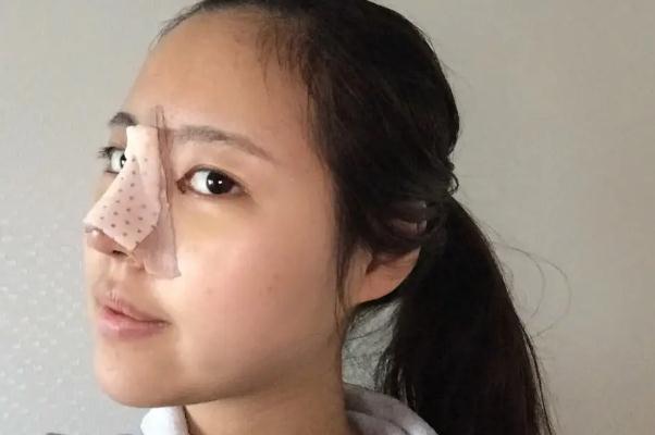 耳軟骨隆鼻有異物感 耳軟骨隆鼻有鼻炎可以做嗎 耳軟骨隆鼻有異物感 耳軟骨隆鼻有鼻炎可以做嗎