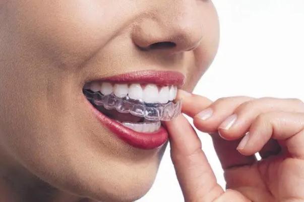 戴牙套有什么副作用 戴牙套有什么用 戴牙套有什么副作用 戴牙套有什么用