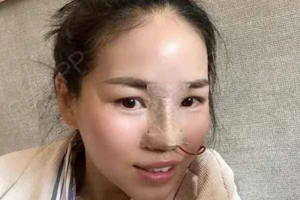 耳軟骨隆鼻會(huì)攣縮嗎 耳軟骨隆鼻會(huì)變形嗎