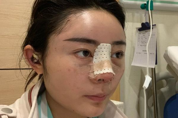 膨體隆鼻的膨體是什么東西 膨體隆鼻要開刀嗎 膨體隆鼻的膨體是什么東西 膨體隆鼻要開刀嗎