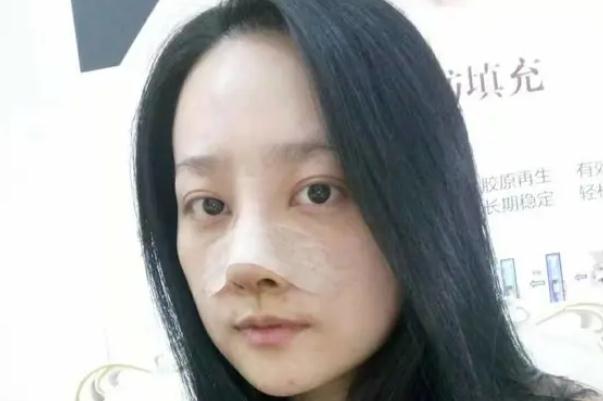 膨體隆鼻要多久才會(huì)恢復(fù)自然 膨體隆鼻要墊鼻尖嗎 膨體隆鼻要多久才會(huì)恢復(fù)自然 膨體隆鼻要墊鼻尖嗎