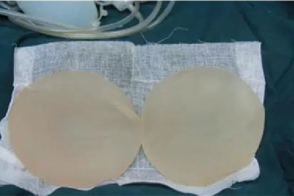 假體隆胸可以一輩子不取出來(lái)嗎 假體隆胸是怎么放進(jìn)去的 假體隆胸可以一輩子不取出來(lái)嗎 假體隆胸是怎么放進(jìn)去的