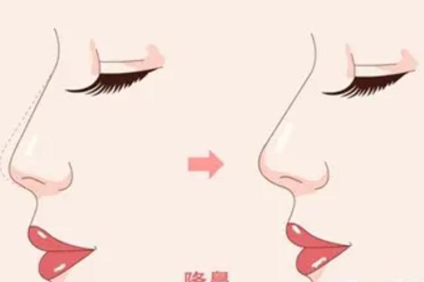 膨體隆鼻有積液是不是感染了 膨體隆鼻有積液怎么辦 膨體隆鼻有積液是不是感染了 膨體隆鼻有積液怎么辦