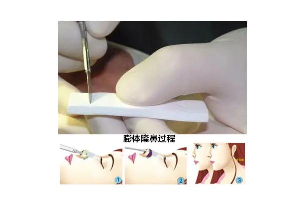 膨體隆鼻可以一輩子不取出來嗎 膨體隆鼻可以維持多少年 膨體隆鼻可以一輩子不取出來嗎 膨體隆鼻可以維持多少年