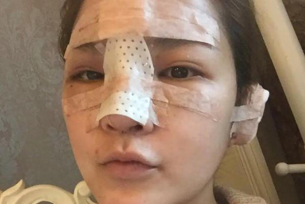 膨體隆鼻的膨體是什么東西 膨體隆鼻要開刀嗎 膨體隆鼻的膨體是什么東西 膨體隆鼻要開刀嗎