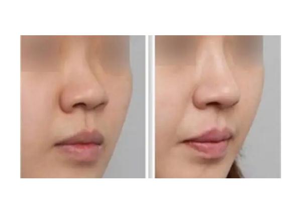 膨體隆鼻會(huì)移位嗎 膨體隆鼻會(huì)透光嗎 膨體隆鼻會(huì)移位嗎 膨體隆鼻會(huì)透光嗎