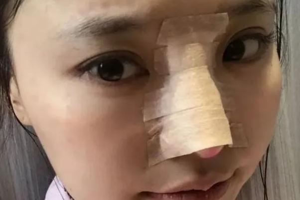 膨體隆鼻的膨體是什么東西 膨體隆鼻要開刀嗎 膨體隆鼻的膨體是什么東西 膨體隆鼻要開刀嗎