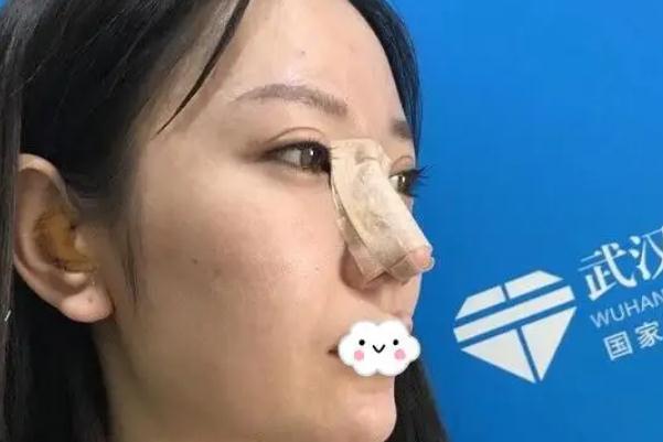 膨體隆鼻要多久才會(huì)恢復(fù)自然 膨體隆鼻要墊鼻尖嗎 膨體隆鼻要多久才會(huì)恢復(fù)自然 膨體隆鼻要墊鼻尖嗎