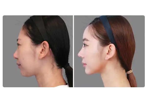 墊下巴什么方式最安全永久 墊下巴手術風險大嗎 墊下巴什么方式最安全永久 墊下巴手術風險大嗎