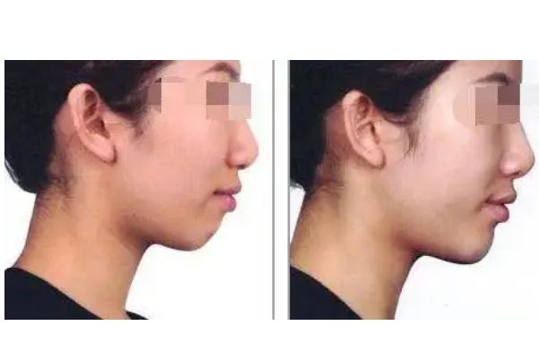 墊下巴要住院嗎 墊下巴要換身份證嗎 墊下巴要住院嗎 墊下巴要換身份證嗎