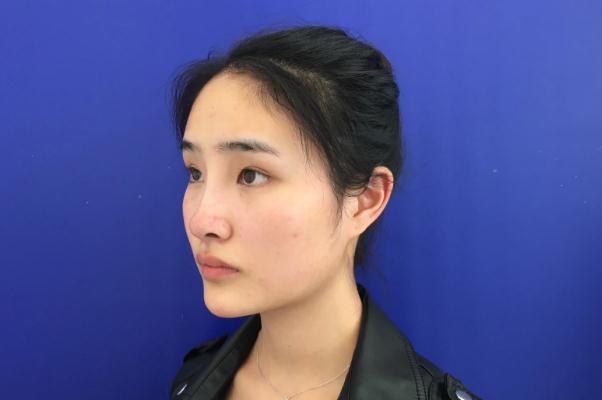 墊下巴是幾級手術(shù) 墊下巴是永久的嗎 墊下巴是幾級手術(shù) 墊下巴是永久的嗎