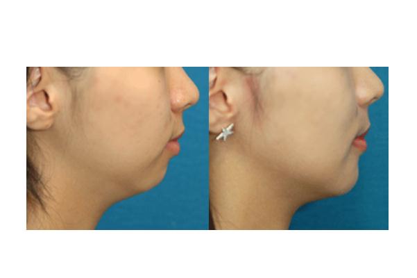 墊下巴什么方式最安全永久 墊下巴手術風險大嗎 墊下巴什么方式最安全永久 墊下巴手術風險大嗎