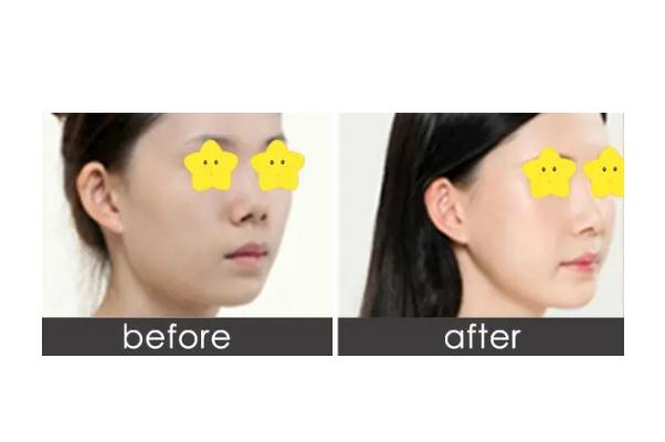 墊下巴能摸出來嗎 墊下巴能墊多少厘米 墊下巴能摸出來嗎 墊下巴能墊多少厘米