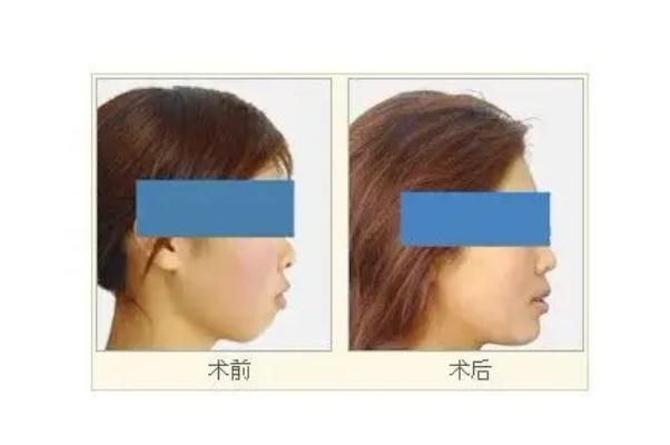 墊下巴會(huì)不會(huì)一碰就歪了 墊下巴會(huì)影響戴牙套嗎 墊下巴會(huì)不會(huì)一碰就歪了 墊下巴會(huì)影響戴牙套嗎