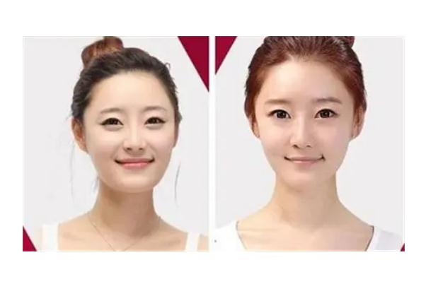 墊下巴是幾級手術(shù) 墊下巴是永久的嗎 墊下巴是幾級手術(shù) 墊下巴是永久的嗎