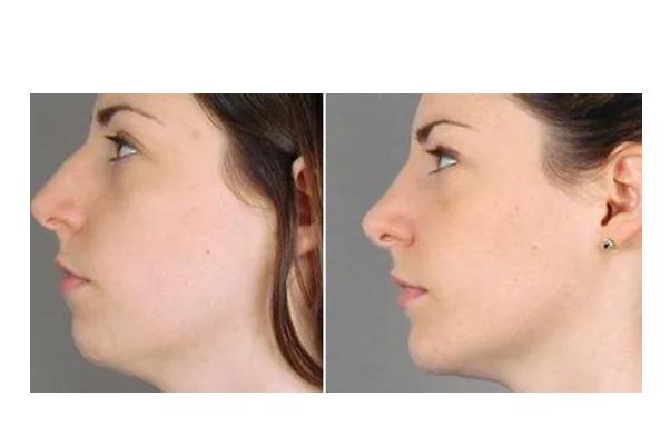 墊下巴有什么用 墊下巴有什么副作用 墊下巴有什么用 墊下巴有什么副作用