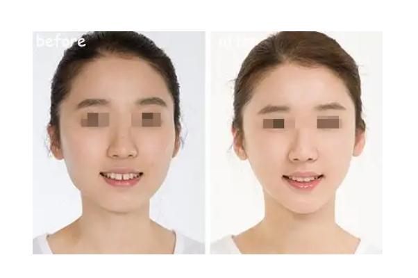 豐下巴哪種方法最好 豐下巴需要多少錢 豐下巴哪種方法最好 豐下巴需要多少錢