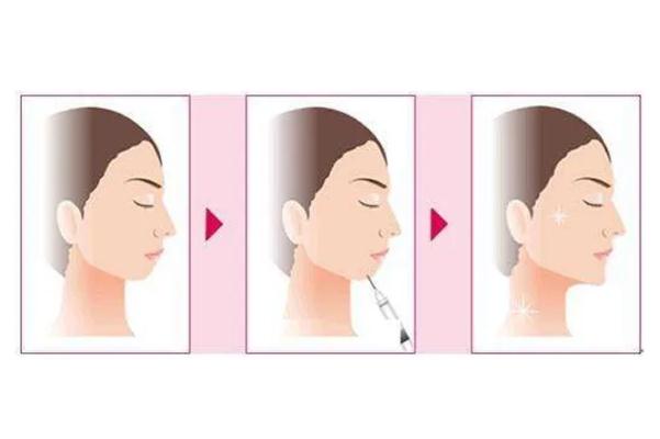 豐下巴是永久的嗎 豐下巴是從正面還是側(cè)面 豐下巴是永久的嗎 豐下巴是從正面還是側(cè)面