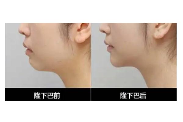 豐下巴哪種方法最好 豐下巴需要多少錢 豐下巴哪種方法最好 豐下巴需要多少錢