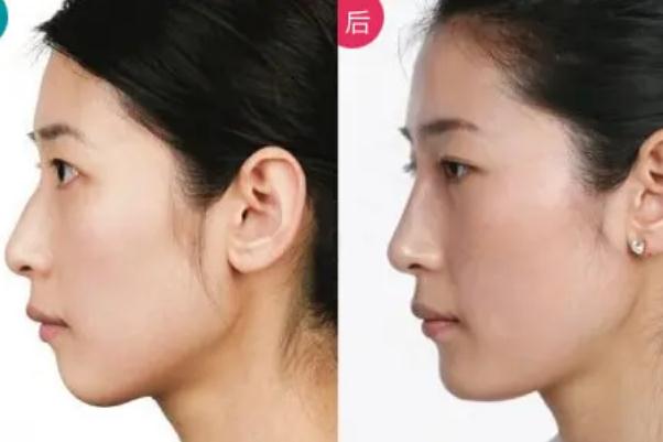 豐下巴的原理 豐下巴的副作用 豐下巴的原理 豐下巴的副作用