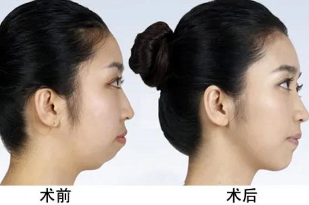 豐下巴用大分子還是小分子 豐下巴有幾種方法 豐下巴用大分子還是小分子 豐下巴有幾種方法