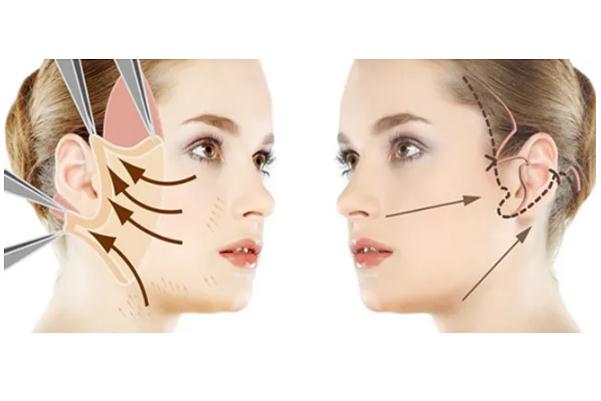 拉皮手術能維持幾年 拉皮手術多久恢復自然 拉皮手術能維持幾年 拉皮手術多久恢復自然