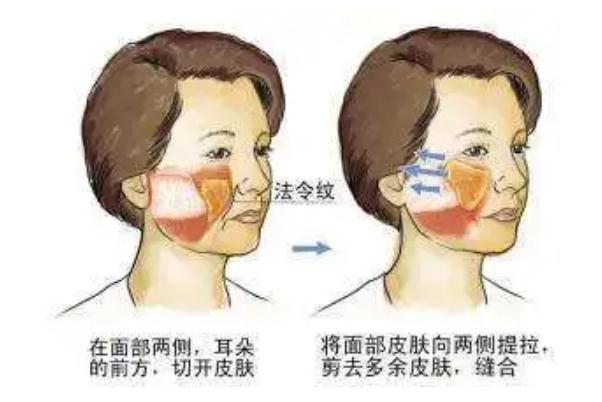 拉皮手術(shù)可以做哪些部位 拉皮手術(shù)可以吃芒果嗎 拉皮手術(shù)可以做哪些部位 拉皮手術(shù)可以吃芒果嗎