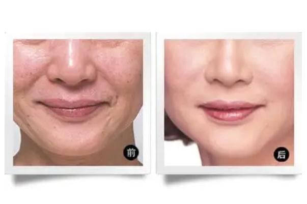 拉皮手術(shù)有生命危險(xiǎn)嗎 拉皮手術(shù)會(huì)留疤痕嗎 拉皮手術(shù)有生命危險(xiǎn)嗎 拉皮手術(shù)會(huì)留疤痕嗎