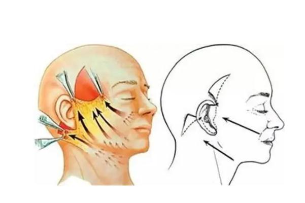 拉皮手術是拉的筋膜層還是皮膚層 拉皮手術是大手術嗎 拉皮手術是拉的筋膜層還是皮膚層 拉皮手術是大手術嗎