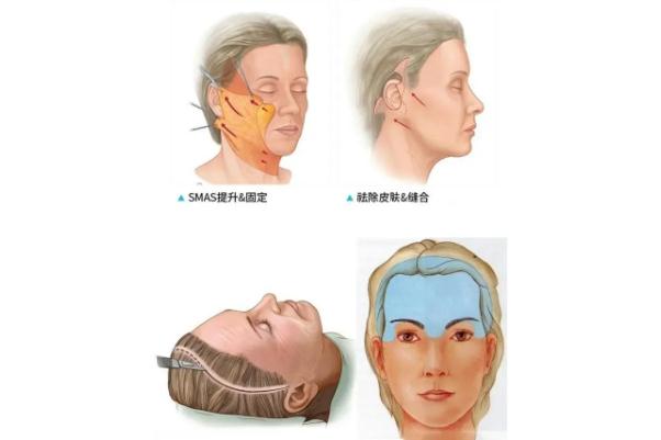 拉皮手術能維持幾年 拉皮手術多久恢復自然 拉皮手術能維持幾年 拉皮手術多久恢復自然