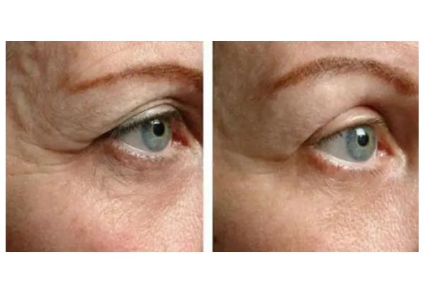 拉皮手術(shù)有生命危險(xiǎn)嗎 拉皮手術(shù)會(huì)留疤痕嗎 拉皮手術(shù)有生命危險(xiǎn)嗎 拉皮手術(shù)會(huì)留疤痕嗎