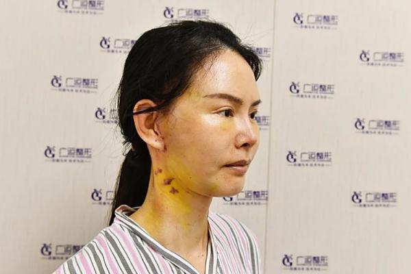 拉皮手術(shù)會把鼻子拉寬嗎 拉皮手術(shù)會腫幾天 拉皮手術(shù)會把鼻子拉寬嗎 拉皮手術(shù)會腫幾天