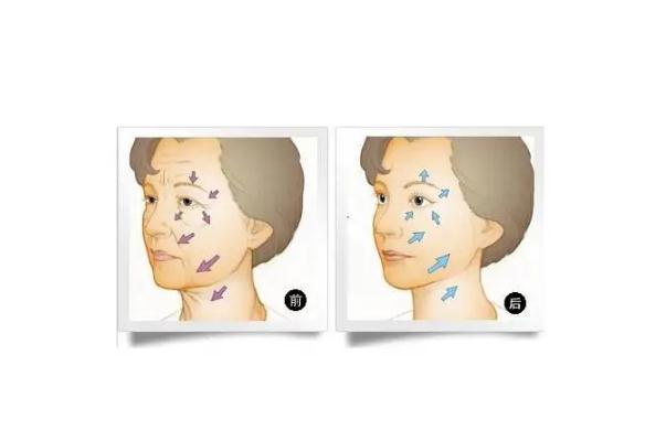 拉皮手術(shù)的疤痕多久消失 拉皮手術(shù)是全麻還是局麻 拉皮手術(shù)的疤痕多久消失 拉皮手術(shù)是全麻還是局麻