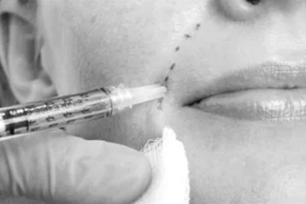 童顏針會(huì)凹凸不平嗎 童顏針對身體有害嗎 童顏針會(huì)凹凸不平嗎 童顏針對身體有害嗎