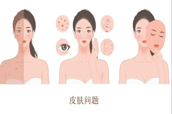 刷酸適合什么皮膚 刷酸適合夏天還是冬天 刷酸適合什么皮膚 刷酸適合夏天還是冬天