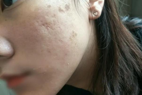 紅藍(lán)光祛痘的作用及副作用 紅藍(lán)光祛痘到底有沒(méi)有效果 紅藍(lán)光祛痘的作用及副作用 紅藍(lán)光祛痘到底有沒(méi)有效果