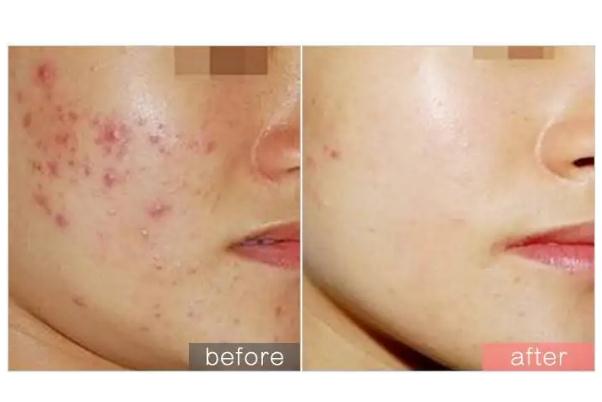 紅藍(lán)光祛痘印多久見效 紅藍(lán)光祛痘要做多少次 紅藍(lán)光祛痘印多久見效 紅藍(lán)光祛痘要做多少次
