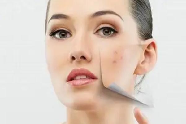 激光祛痘有副作用么 激光祛痘有后遺癥嗎 激光祛痘有副作用么 激光祛痘有后遺癥嗎