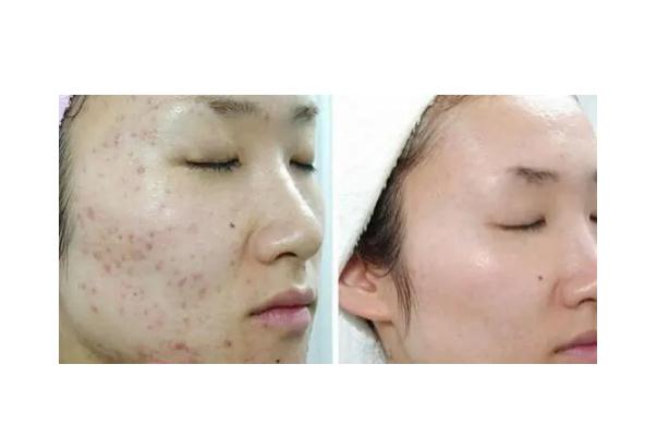 激光祛痘是永久的嗎 激光祛痘是全臉還是局部 激光祛痘是永久的嗎 激光祛痘是全臉還是局部