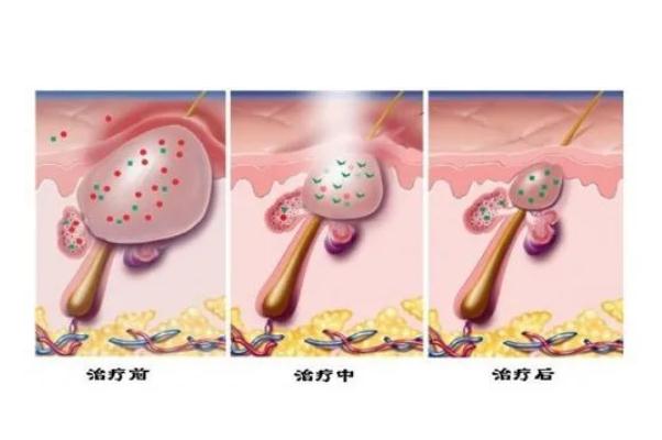 激光祛痘可以根治嗎 經(jīng)期可以做激光祛痘嗎 激光祛痘可以根治嗎 經(jīng)期可以做激光祛痘嗎