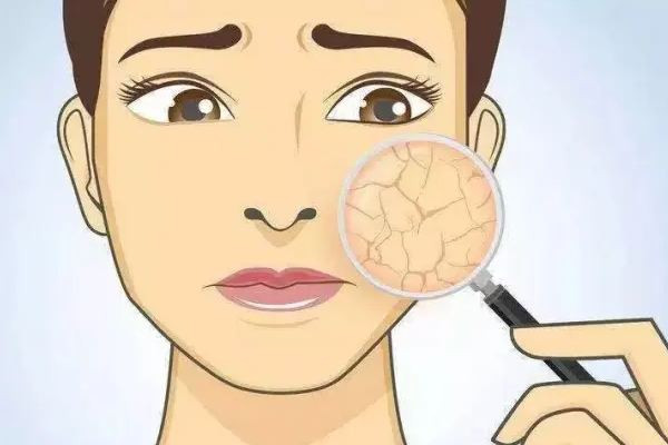 刷酸后臉上起了好多小痘痘怎么辦 刷酸后臉上干燥起皮怎么辦 刷酸后臉上起了好多小痘痘怎么辦 刷酸后臉上干燥起皮怎么辦